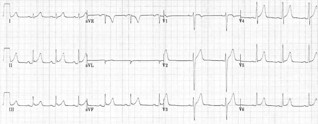 ECG Benign Early Repolarisation BER 1
