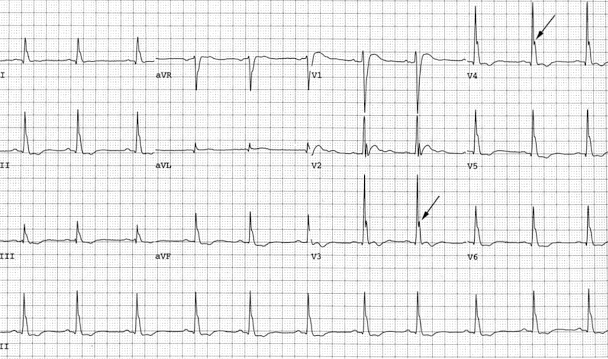 ECG Osborn waves in severe hypercalcaemia