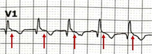 Pseudo R' waves in AVNRT