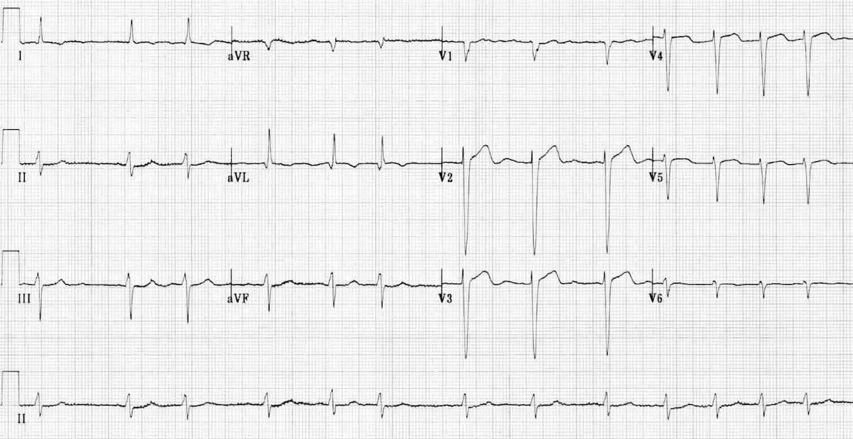 ECG Atrial Fibrillation 3