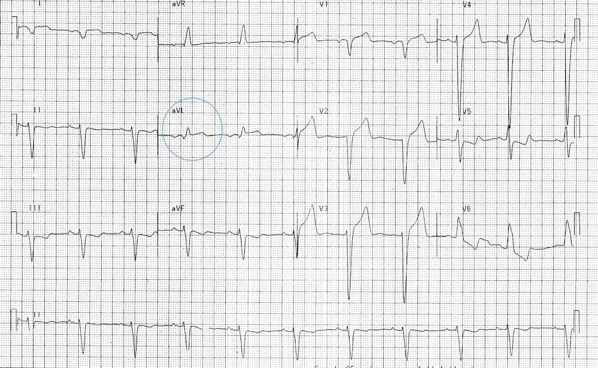 LBBB-with-Sgarbossa