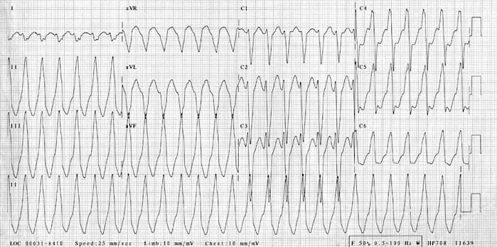 ECG RVOT LBBB VT Inferior Axis