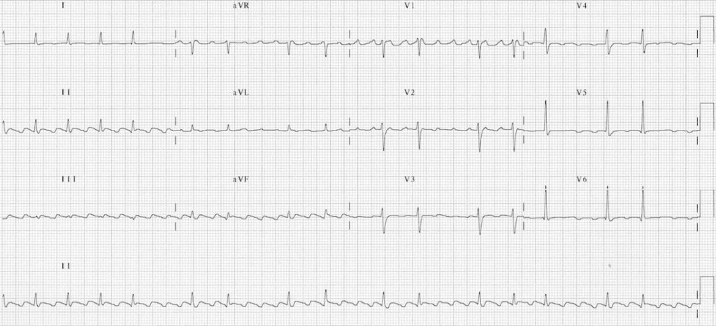 TOP 100 ECG QUIZ LITFL 053