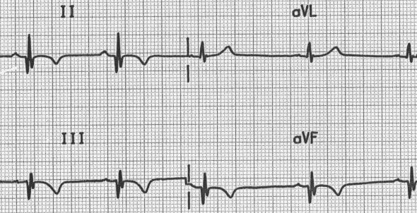 Q waves with old inferior AMI