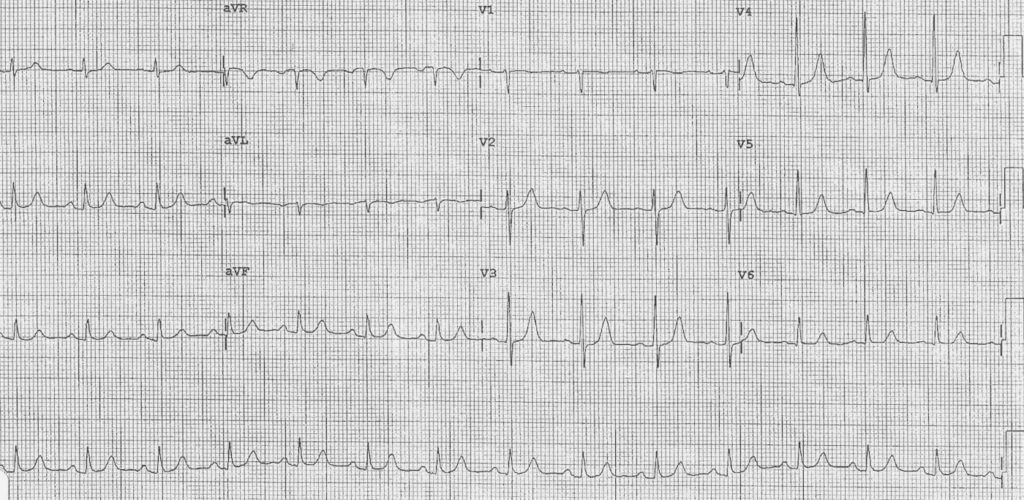 ECG 078a LITFL Top 100