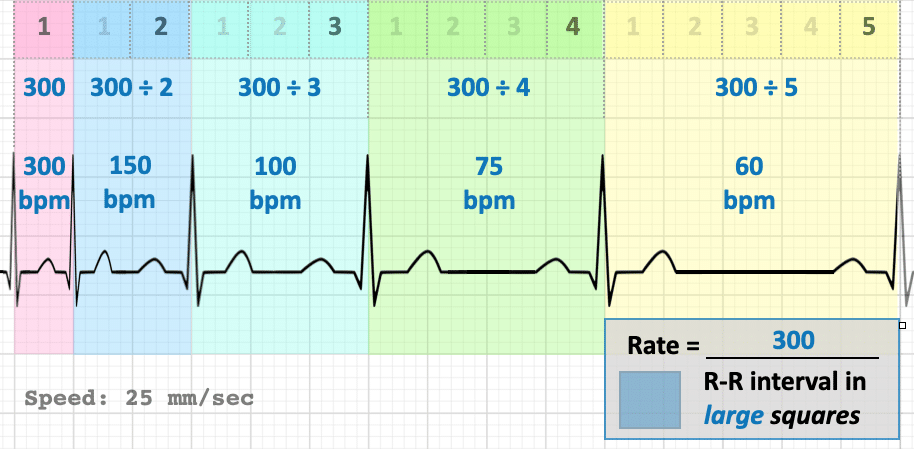 ECG rate calculation Large square method