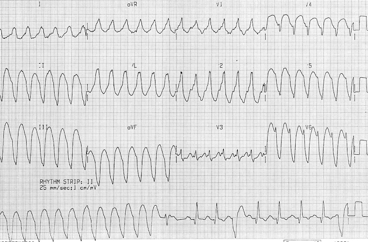 Monomorphic ventricular tachycardia VT 2