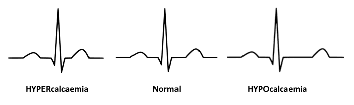 ECG-QT-changes-Hypocalcaemia-Hypercalcaemia 2