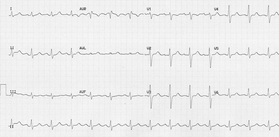 ECG Massive Carbemazepine OD 1