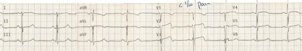TOP 100 ECG QUIZ LITFL 005 2b