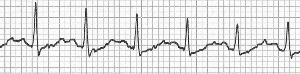 ECG Camel hump hidden p waves