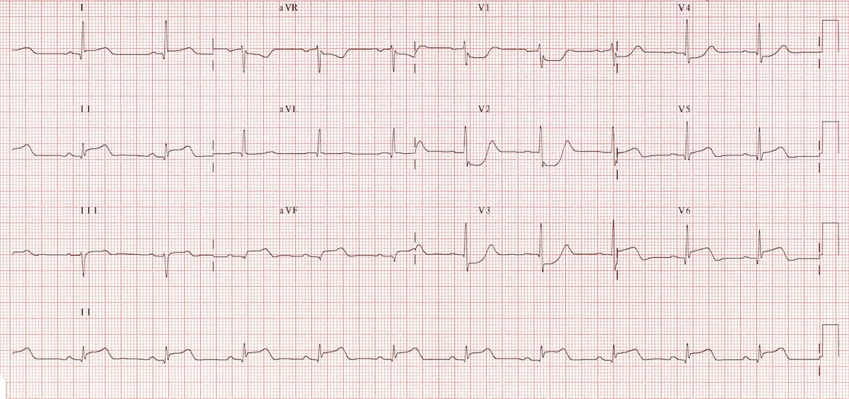 ECG Posterior AMI 1