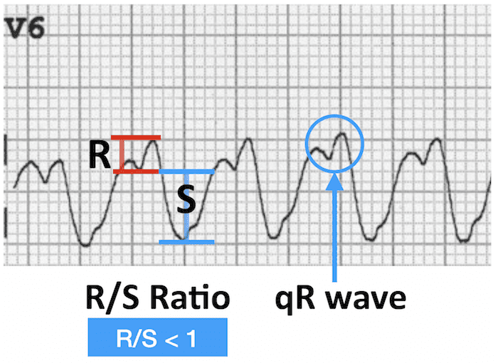 ECG VT V6 qR wave LBBB morphology 700