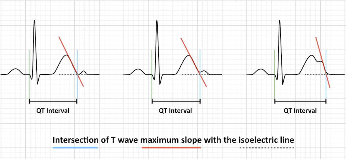 QT interval with u waves maximum T wave slope intersection