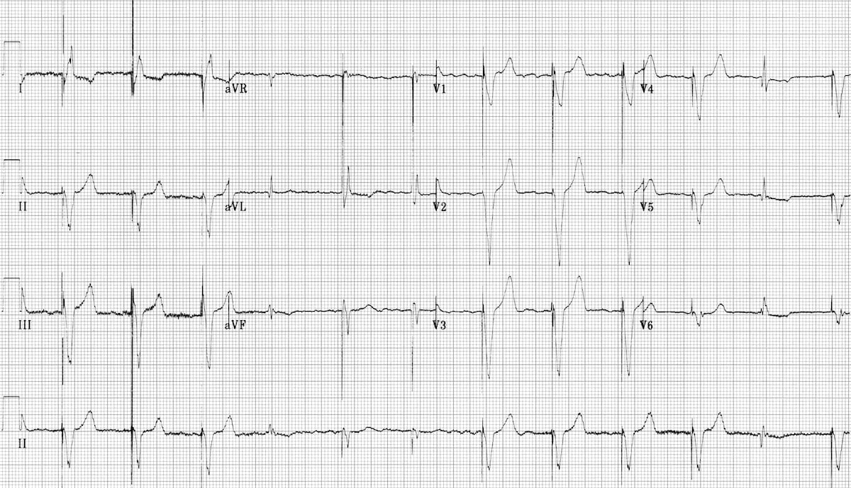 Ventricular-pacing-with-AF-and-fusion-beats 2