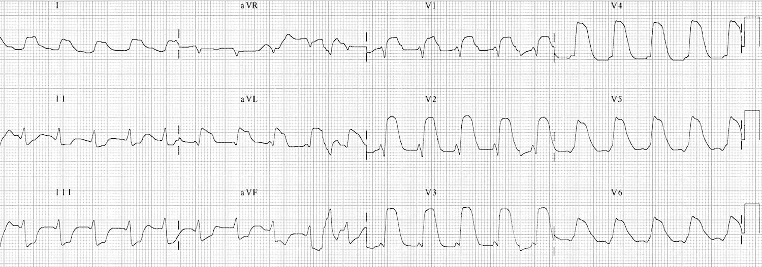 ECG Extensive anterior MI ("tombstoning" pattern)
