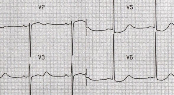 U waves associated with quinidine use