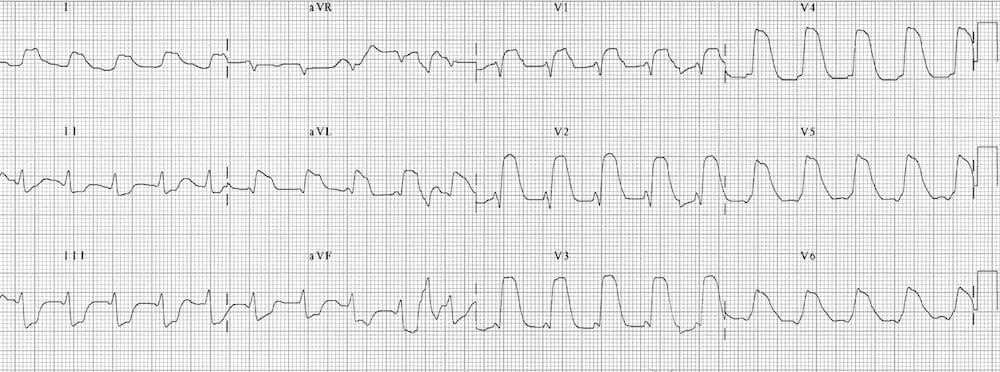 TOP 100 ECG QUIZ LITFL 026 2