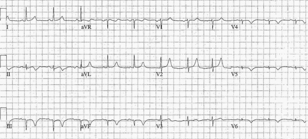 ECG Case 081a LITFL Top 100 EKG