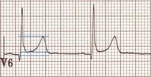 ST-segment-T-wave-ratio-Benign Early Repolarisation