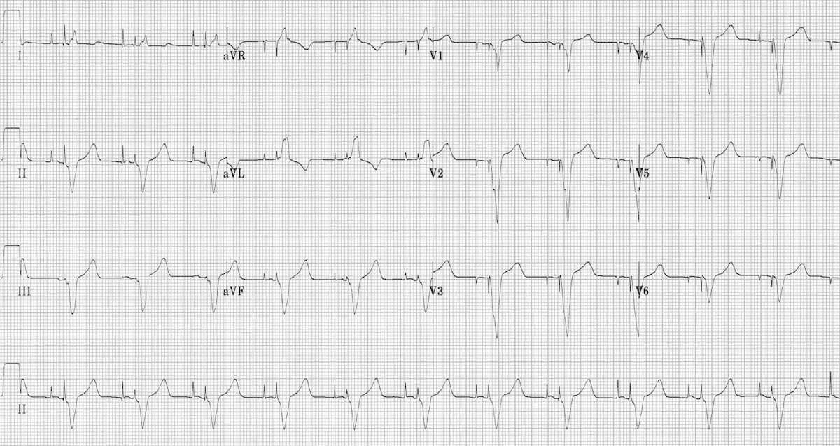 AV-sequential-pacing-1 2