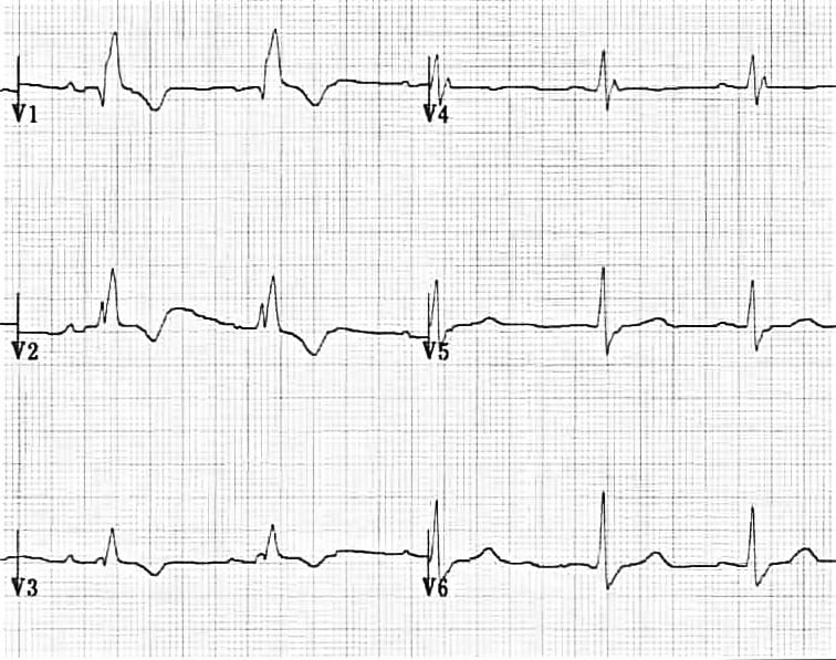 ECG Right Bundle Branch Block RBBB T wave inversion