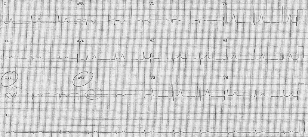 ECG 078b LITFL Top 100