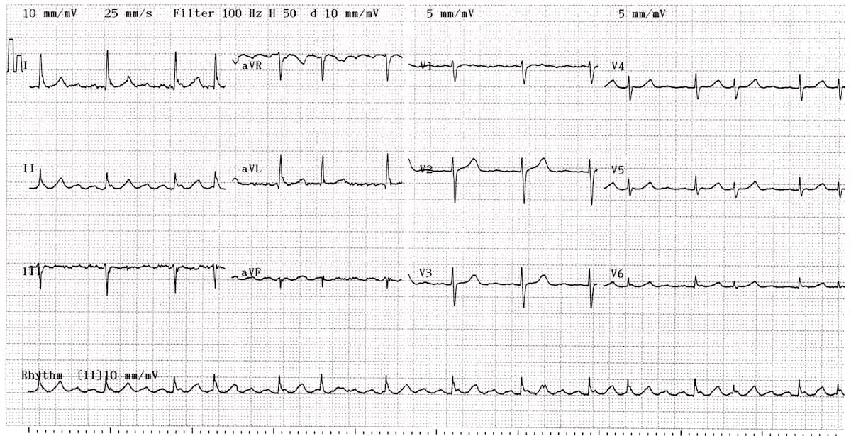 ECG Atrial Flutter variable block 2:1 4:1