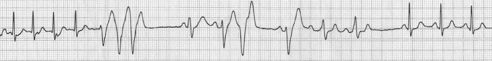 AVNRT reverts to sinus rhythm Adenosine