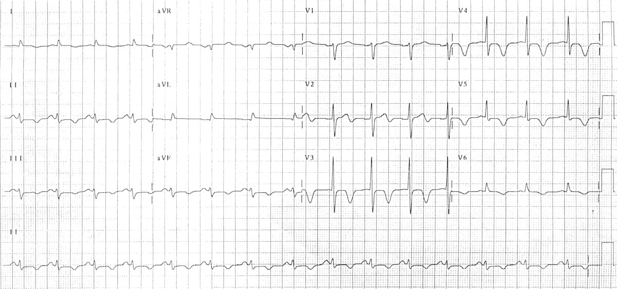 Subarachnoid Haemorrhage ECG