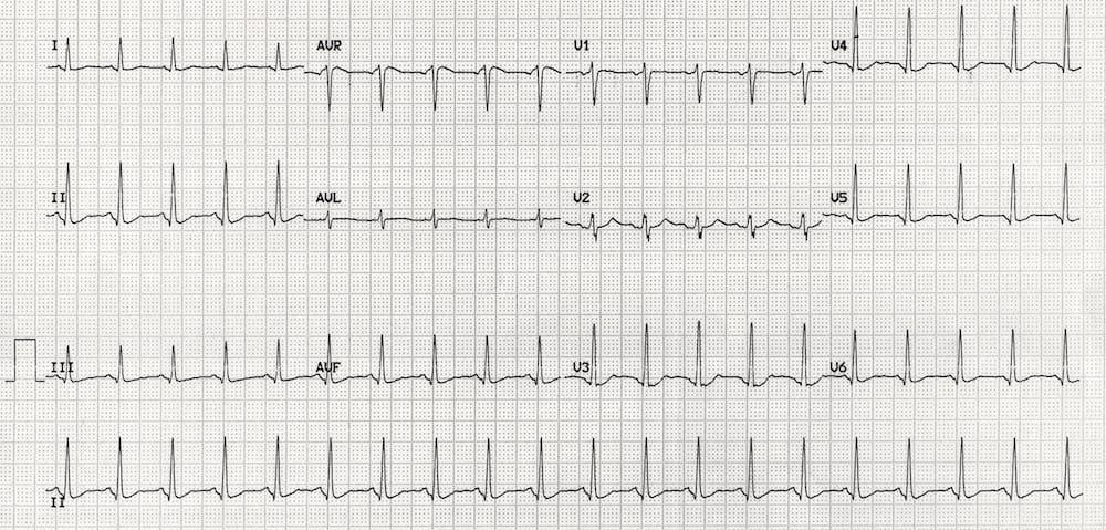 TOP 100 ECG QUIZ LITFL 022