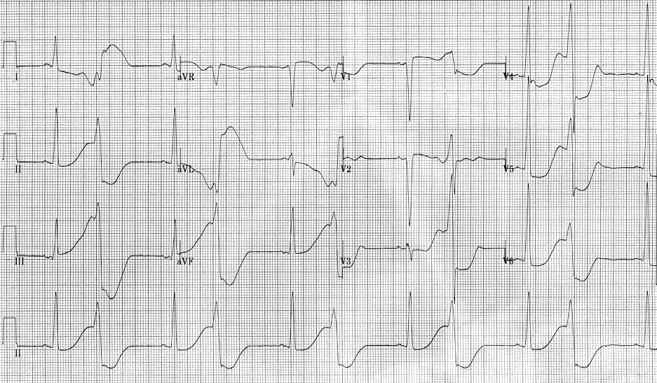 ECG R on T 2