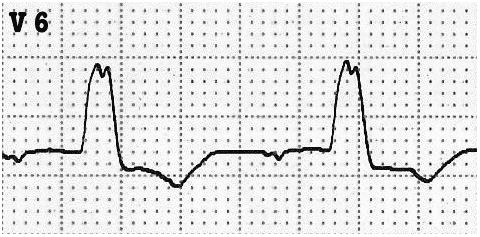 ECG LBBB V6 absent Q waves