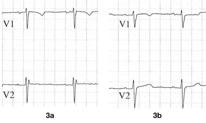 Figure 3 IRBBB (a) with resolution (b)