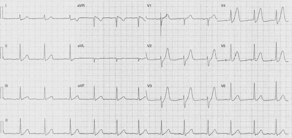 ECG Case 085b LITFL Top 100 EKG