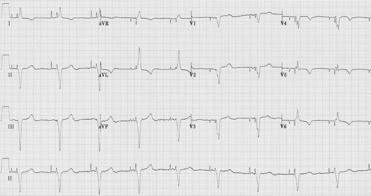 AV-sequential-pacing-2 2