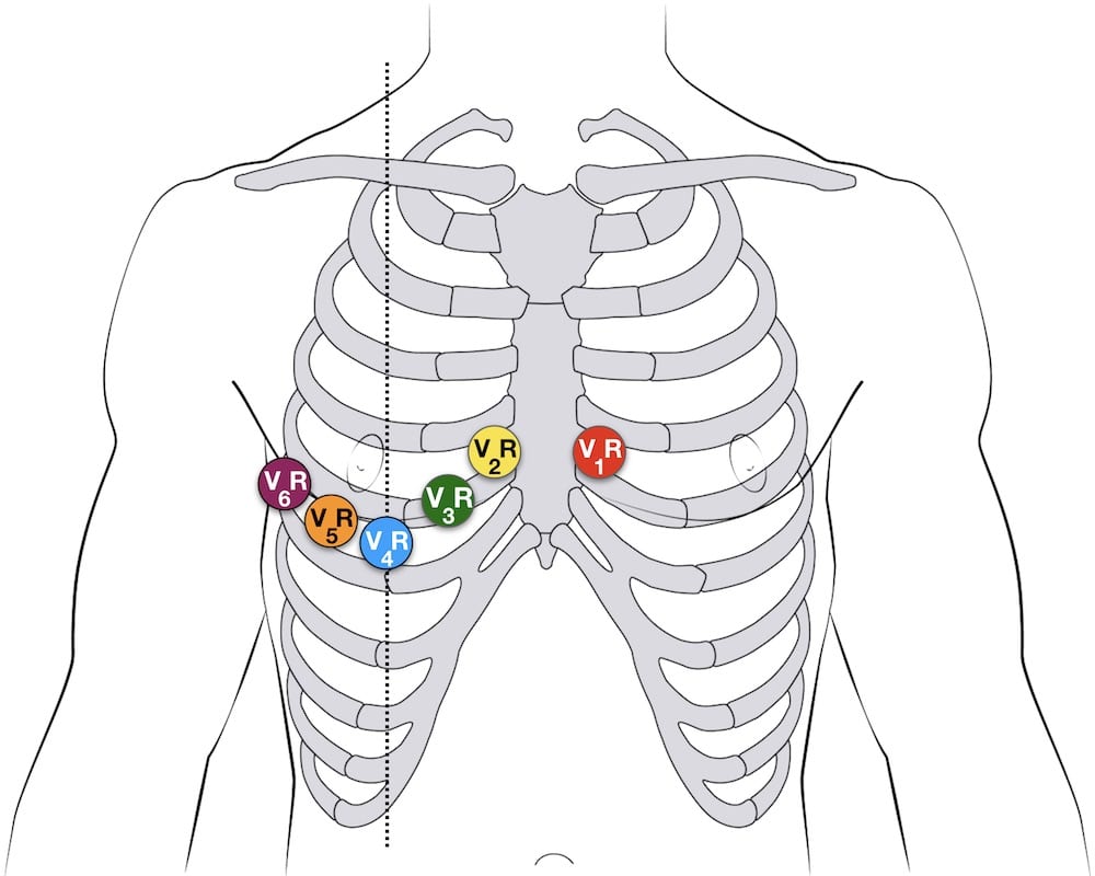 Right sided 12 lead ECG lead placement