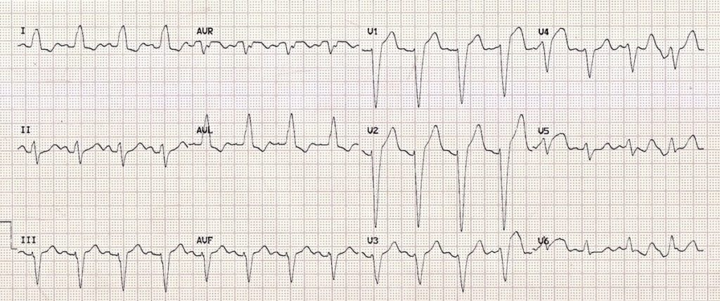 ECG-Left-Bundle-Branch-Block-LBBB-2-2
