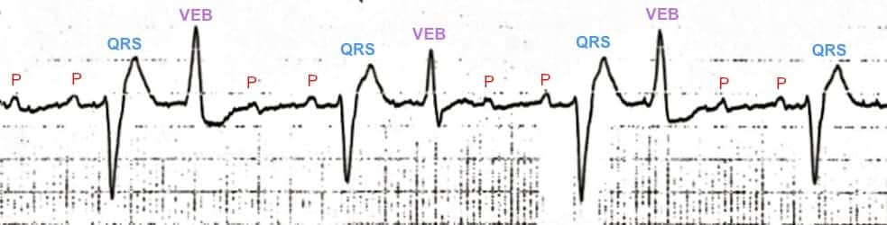 Digoxin Toxicity ECG Rhythm strip