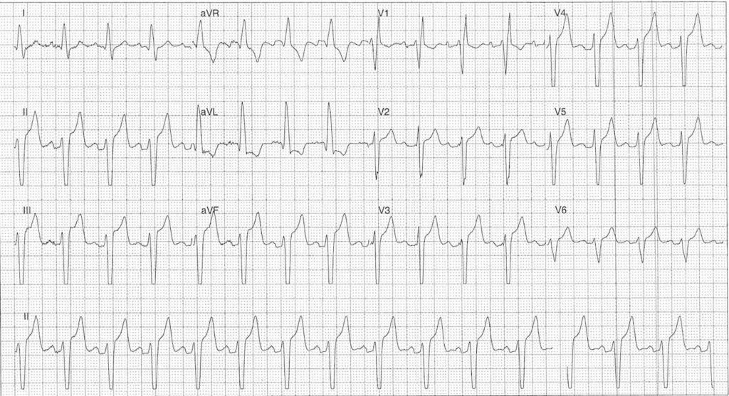 ECG Case 108a LITFL Top 100 EKG