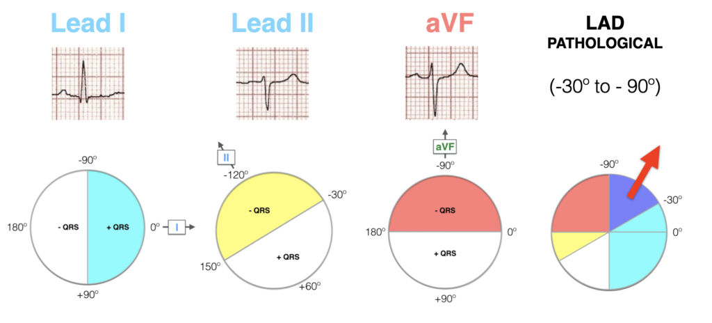 Lead I II aVF Hexaxial Evaluation LAD Pathological 2021