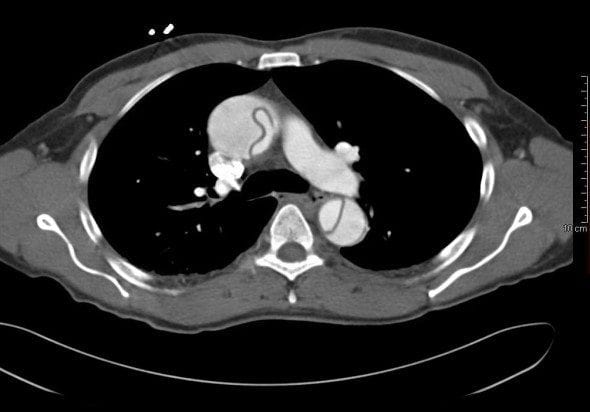 Thoracic aorta aneurysm