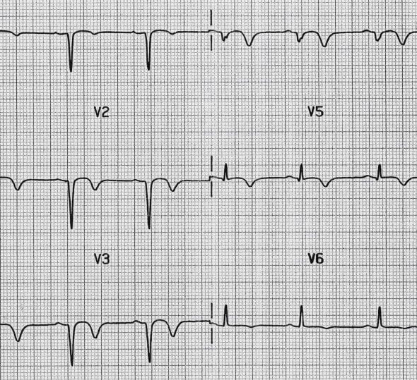 Anterior T wave inversion with Q waves
