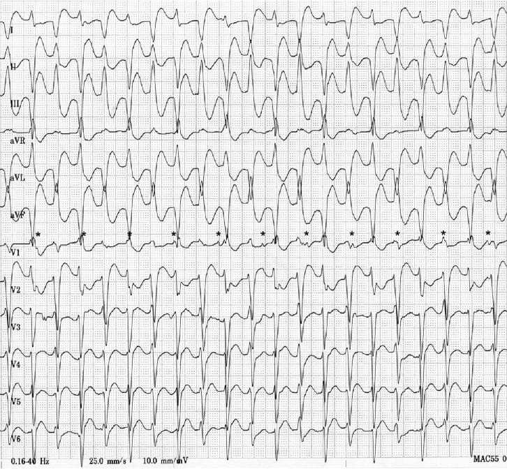 ECG Bidirectional Ventricular Tachycardia BVT 4