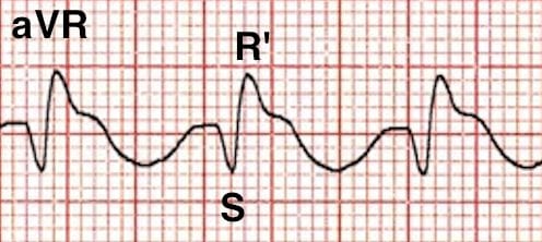 Positive R’ wave in aVR