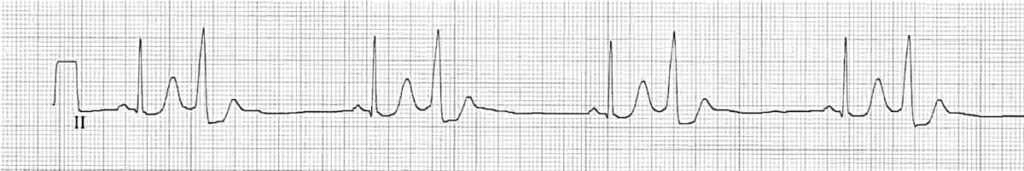 ECG Strip QRS narrow and wide