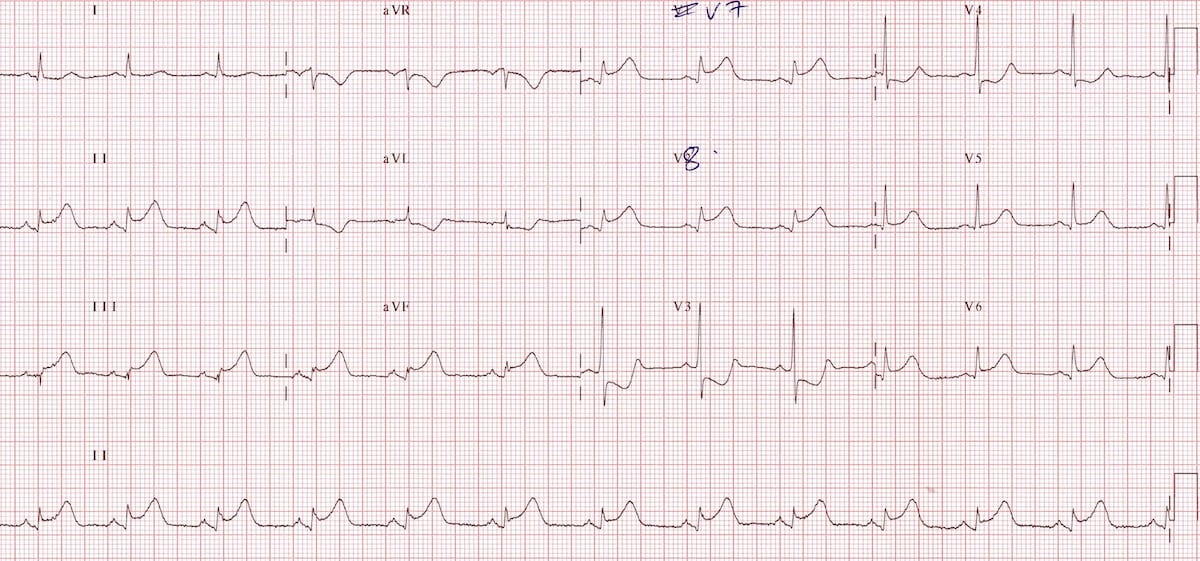 ECG Posterior AMI 4a V789