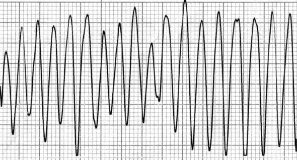 ECG Ventricular flutter