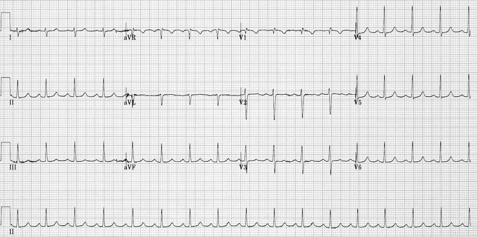 Typical-AVNRT-resolved 2