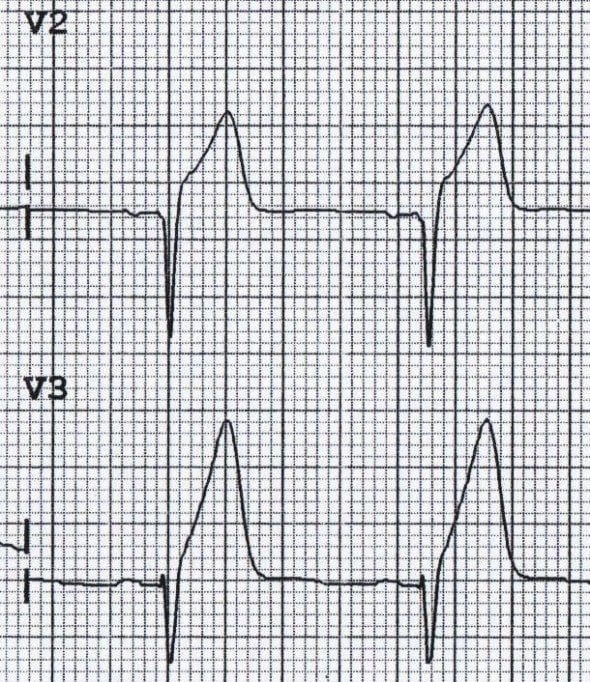 Hyperacute T waves due to anterior STEMI